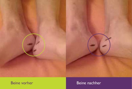 Beine Vorher Nachher