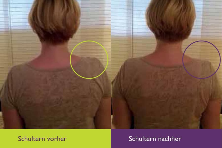 schultern-vorher-nachher